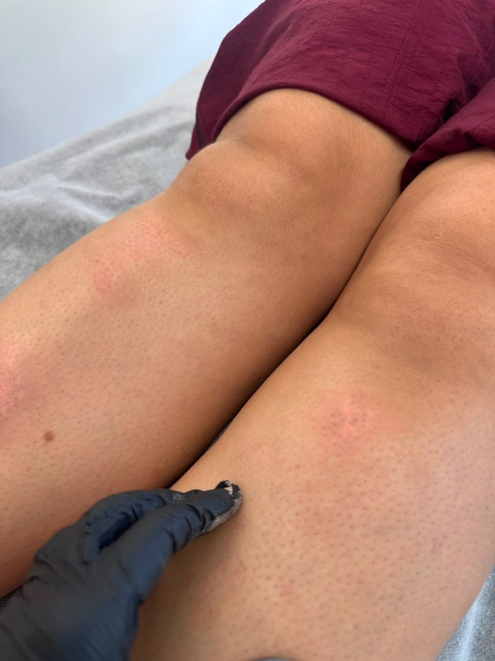Vitiligo — après